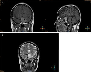 MRI of a patient with a clinically nonfunctioning pituitary macroadenoma, showing suprasellar and left parasellar extension: A, T1-weighted, gadolinium-enhanced coronal and sagittal views; B, T2-weighted coronal view.