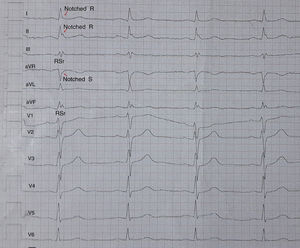 Different morphologies of an fQRS on a 12-lead ECG.