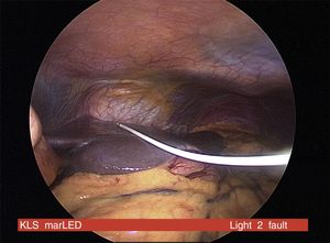 DiaPort catheter change via laparoscopy. Image during the procedure.