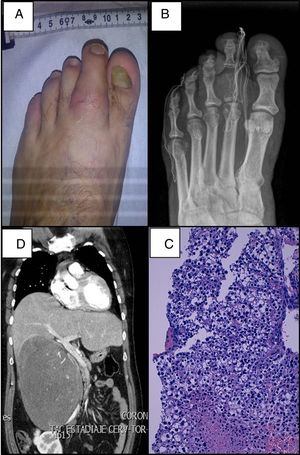 A: tumefacción en el segundo dedo del pie izquierdo. B: lesión ósea lítica en la falange proximal del segundo dedo del pie. C: infiltración ósea por células tumorales, tinción hematoxilina-eosina (x100). D: tomografía axial computarizada que muestra gran masa suprarrenal derecha que produce desplazamiento de estructuras adyacentes.