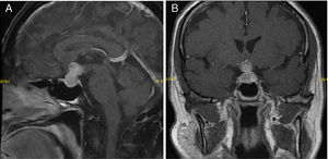 Imágenes de metástasis hipofisaria en la RMN: A) Corte sagital de la RMN del caso 1. B) Corte coronal de la RMN del caso 2.
