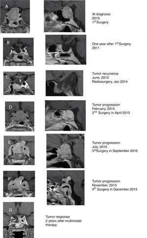 Coronal (left) and sagittal (right) gadolinium-enhanced T1-weighted MRI images at diagnosis (A). MRI images one year after surgery showing postoperative changes in relation to almost complete resection of the tumor, with the optic chiasm in normal situation and slight displacement of the pituitary stalk to the left (B). MRI in 2013 showing a radiological tumor progression that was treated with radiosurgery in 2014 (C). MRI in February 2015 showing radiological tumor progression which was treated with a subtotal resection of the tumor (D). MRI in July 2015 showing radiological tumor progression which was reoperated via an endonasal endoscopic posterior-transphenoidal approach with a subtotal resection of the tumor (E). MRI in November 2015 showing radiological tumor progression (F). Tumor response after 2 years (G) of multimodal therapy with radiotherapy, DA, SSA, and TMZ showing a significant reduction in tumor size.