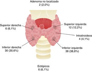 Localización quirúrgica de los adenomas paratiroideos en el estudio (n=98).