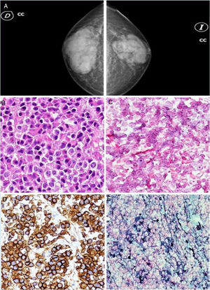 A) Mamografía que muestra un incremento de tejido glandular mamario bien definido, más intenso en el lado derecho. B) BAG: se visualiza infiltrado en sábana de células plasmáticas. C) Cadenas kappa negativas. D) CD138 positivo para células plasmáticas. E) Cadenas lambda positivas.