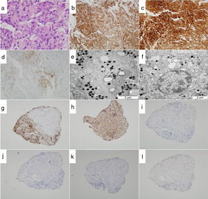 Estudio anatomopatológico e inmunohistoquímico del tumor hipofisario (cortes consecutivos). a)Microestructura del SCO basada en células con cambios oncocíticos con abundante citoplasma eosinofílico (HE, ×29). b-d)Tinciones inmunohistoquímicas: b, vimentina; c, proteína S-100; d, EMA (×10). La inmunohistoquímica fue negativa para CD34, proteína glial, desmina y C-kit (no se muestra). e-f)Estudio ultraestructural mediante microscopia electrónica. Se observan células oncocíticas con abundantes gránulos secretores y mitocondrias. Magnificación: ×10.500 (f), ×13.500 (e). g-l)Inmunoperfil: g, ACTH; h, GH; i, FSH; j, LH; k, TSH; l, prolactina (×2,5).