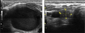 Initial and final ultrasound appearance of a treated thyroid cysts. Transverse ultrasound scans of one cyst before (panel A) and after (panel B) percutaneous ethanol injection treatment (PEIT), showing a marked decrease in size.