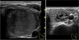 Intracystic hemorrhage during percutaneous ethanol injection procedure. Self-limited intracystic hemorrhage that occurred after the first drainage showing partial spontaneous absorption over time and which was totally extracted with the following PEI procedure.