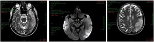 Diffusion-weighted MRI control showed stroke-like lesions in the temporal, parieto-occipital regions, predominantly in the left hemisphere.