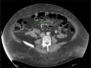 TC abdominal con contraste iv realizado en el caso 2. Se señala un agrupamiento e ingurgitación de vasos en hemiabdomen izquierdo que evidencia la posibilidad de brida peritoneal/hernia interna. Sin embargo, no se aprecia dilatación de asas.