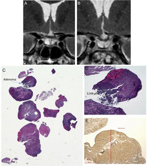 Histopathological sample of ACTH-secreting pituitary adenoma not visible on preoperative MRI. (A) Coronal T2 preoperative MRI; (B) Coronal T2 postoperative MRI (reduction of glandular parenchyma was observed after surgery); (C) Material sent HE (macro) where the small fragment of 1mm in diameter corresponding to the tumour is observed); (D) Adenoma HE 4×; (E) Immunohistochemical staining with 4× ACTH antibody.