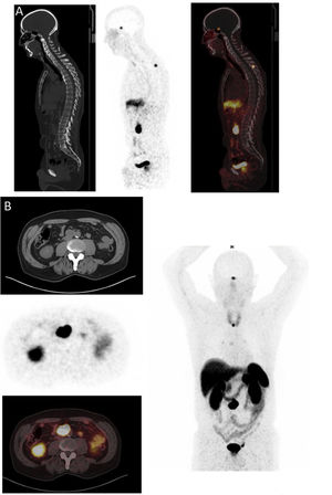 Lesión ósea en paciente con PGL metastásico visualizado en el [68Ga]DOTA-TOC PET-TC.