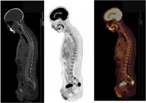 Paraganglioma metastásico con lesión sacra en paciente con mutación en SDHB.