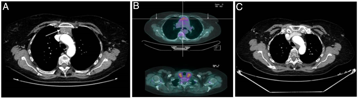 Hiperplasia tímica transitoria asociada a tiroiditis | Endocrinología ...