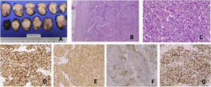 Morphological and immunohistochemical features of a small cell NEC. (A) Lymph node with 22g and 52mm×30mm×21mm. (B) HE 40×, histopathology showing organoid and diffuse growth with necrosis. (C) HE 400×, tumor cells show round nuclei with fine granular chromatin, inconspicuous nucleoli, nuclear molding, high nuclear-cytoplasmic ratio, scant cytoplasm, and mitotic figures. Diffuse immunoreactivity to (D): cytokeratin CAM5.2 and (E) synaptophysin in tumor cells. (F) Chromogranin A immunostaining is present in some cells, with faint intensity. (G) Ki-67 labeling index is 80–90%.