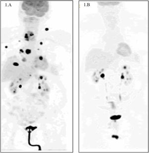 A) Tomografía por emisión de positrones con 18F-fluorodesoxiglucosa (PET/FDG) al diagnóstico. Se observa masa cervical derecha con incremento de la actividad metabólica con una SUVmáx de 28,5 e imágenes sugestivas de metástasis pulmonares bilaterales múltiples, ganglionares (en zona supraclavicular derecha y axilar izquierda), musculares y en aurícula derecha. B) PET/FDG tras 11 meses de tratamiento con inhibidores de BRAF/MEK (drabefenib-trametinib). Se observa involución morfometabólica de la masa cervical derecha, con desaparición de las lesiones metastásicas a todos los niveles.