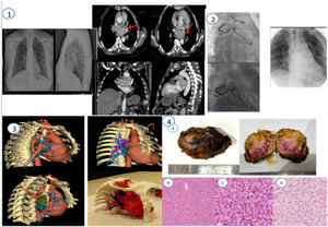 (1) Rx de tórax PA y lateral. Angio-TC de tórax con contraste i.v. al diagnóstico. Se visualiza tumoración de gran tamaño en mediastino medio, próxima a carina, que se nutre de irrigación coronaria y bronquial. (2) Resultado tras la embolización con Onix de las ramas coronarias y de las ramas bronquiales por parte de RVI. (3) Modelo para planificación quirúrgica con reconstrucción 3D. El tumor está representado en color verde. (4) Estudio anatomopatológico. Pieza macroscópica (A). Hematoxilina-eosina 10× a poco aumento donde se aprecia una neoplasia de patrón trabecular/en nidos, vascularizada y con extravasación de hematíes. Las células son redondeadas de citoplasma amplio, eosinofílico y granular y sin atipia manifiesta. (B) Hematoxilina-eosina 40×: A mayor aumento observamos las células de citoplasma amplio, granular y eosinofílico con un núcleo con cromatina en sal y pimienta (C) Reticulina: Con la técnica histoquímica de Reticulina podemos apreciar un rasgo característico de esta entidad ya que se observa cómo las fibras de reticulina se disponen formando cestas o trabéculas en cuyo interior se disponen las células del paraganglioma conformando una disposición conocida como Zellballen (D).