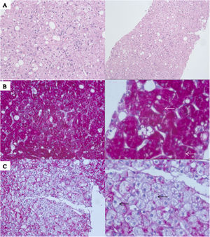 (A) Haematoxylin and eosin staining demonstrates preserved parenchyma architecture with typical hepatocytes diffusely swollen with rarefaction of the cytoplasm, accentuated cell membranes and glycogenation of the nuclei; it may be accompanied with large fatty droplets on liver tissue. (B) Periodic acid-Schiff staining is positive for the presence of glycogen (white arrows). (C) Confirmed after diastase digestion causing the presence of pure glycogen within the hepatocytes (black arrows).