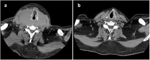Tomogría computarizada cervical con contraste intravenoso, proyección axial al nivel del cricoides: a) en el momento del ingreso; b) 3 meses después.