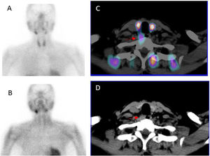A 62-year-old woman with primary hyperparathyroidism. Planar MIBI shows no pathological uptake in early (A) or delayed (B) imaging. However, early SPECT/CT identifies a pre-vertebral parathyroid lesion (C, D), subsequently confirmed in PET Choline. US was negative. A parathyroid adenoma of 220mg was removed by PMI. The patient is biochemically cured.