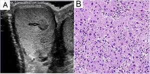 A) Ecografía testicular. Testículo derecho. Lesión sólida, redondeada, hipoecogénica de 6×6mm. B) Detalle de tumor testicular derecho. Células grandes células tumorales eosinófilas (hematoxilina-esoina, x200).