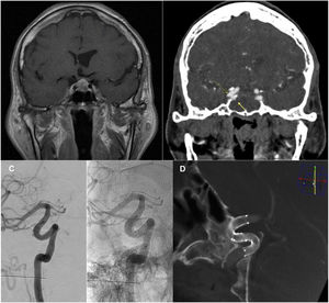 Macroadenoma hipofisario objetivado en RM preoperatoria (A), secuencia T1 con contraste. Angio-TC (B) diagnóstico 20 días p.o. Se identifican 2 pACI (flechas), de cuello ancho y tipo blister, en los segmentos cavernoso (medial, 3,5mm de cuello y 2,5mm de fondo, adyacente a la glándula hipofisaria) y clinoideo (bilobulado, lateral, fondo de 3 y 2,5mm, respectivamente) de la ACI derecha, que se estudiaron también mediante angiografía. C y D) Angiografía de control a los 6 meses (C) y DynaCT® de control a los 15 meses (D) postratamiento endovascular mediante la implantación de 2 stent derivadores de flujo tipo Derivo® solapados. Confirman la permeabilidad de los stent y resolución de los pACI, con permeabilidad de la arteria portadora y ausencia de signos de estenosis ni otras alteraciones intra-stent.