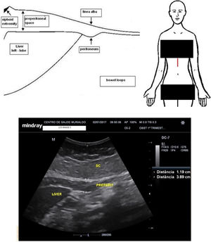 Schematic representation and epigastric adipose tissue (preperitoneal) example.
