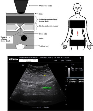 Schematic representation and periumbilical adipose tissue (e.g. Armellini site) example.