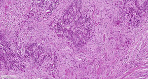 Tinción con hematoxilina y eosina (× 100): paraganglioma gangliocítico.