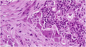 Tinción con hematoxilina y eosina (× 400): paraganglioma gangliocítico.