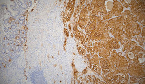 Inmunohistoquímica: cromogranina A + para el componente neuroendocrino, – para células de Schwann.