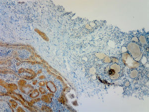 Positive immunohistochemistry with VE-1 monoclonal antibody in a papillary thyroid carcinoma adjacent to an area of normal thyroid tissue (negative).