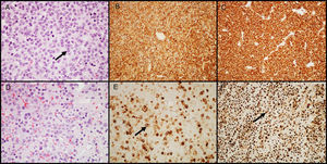 GH-secreting adenomas. (A) Densely granulated GH-secreting adenomas show large cells with eosinophilic granular cytoplasm and a central nucleus with prominent nucleoli (arrow); (B) the tumor shows intense and diffuse immunolabeling for GH; (C) immunolabeling with cytokeratin shows diffuse cytoplasmic reactivity. (D) Sparsely granulated GH-secreting adenomas are characteristically more chromophobic than densely granulated adenomas; (E) GH labeling is heterogeneous and less prominent (arrow); (F) immunohistochemistry with cytokeratin highlights fibrous bodies (arrow). (A and D–HE 400×; B and E–GH 200×; C and F–cytokeratins 8/18 200×).