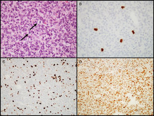 Diagnostic characteristics of atypical pituitary adenomas (example of an atypical null cell adenoma). (A) Several mitotic figures (arrows) are seen in a high power field (HE, 400×). (B) Immunohistochemical confirmation of mitoses with the PHH3 antibody (PHH3, 400×). (C) Tumor shows a high proliferation index (8%, Ki-67, 200×). (D) Extensive nuclear immunoreactivity for p53 (p53, 200×).