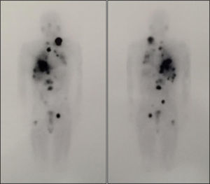 Whole body scan after treatment with 100mCi of 131I-MIBG. The image shows disease progression with lesions with high affinity for the radiotracer that correspond to a left laterocervical adenopathic conglomerate, mediastinal adenopathies, and lung, liver, and bone metastases (L2 and proximal third of right femur).