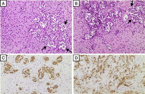 Histopathology of collision sellar tumor. Hematoxylin-eosin stained sections (10×) show a proliferation of fusiform cells in a lax stroma, intermixed with islands of epithelial appearance (arrows) (A, B). Chromogranin expression by epithelial cells (C). Mesenchymal cells present vimentin immunophenotype and positive smooth muscle actin (SMA) (D).