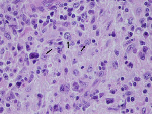 Histological image of the surgical specimen showing lymphocytes within the cytoplasm of macrophages (emperipolesis).
