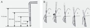 Determination of the Community Periodontal Index (CPI). The WHO periodontal probe, which has a ball tip and black marking of the zone between 3.5 and 5.5mm, and two additional marks at 8.5 and 11.5mm, should be used (A). Each sextant is evaluated based on the following codes: 0: healthy periodontium; 1: bleeding upon mild probing; 2: the presence of supra- or subgingival calculus, no pocket > 3mm; 3: pockets of 4-5mm (partially occult black band of the probe); 4: pockets ≥6mm (occult black band) (B).