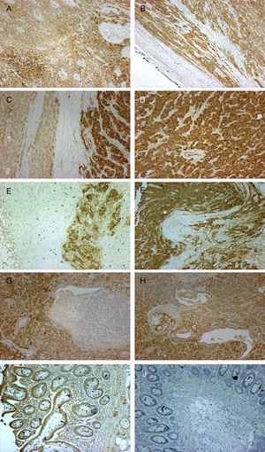 Micrographs showing immunohistochemical staining with anti-IGF2 primary monoclonal antibody (MA5-17096 Thermo Fisher Scientific Pierce; 3,3-diaminobenzidine was used as reaction chromogen, and counterstaining was performed with Mayer hematoxylin for 30s, followed by mounting with VectaMount Permanent Mounting Medium; Vector Laboratories) in histological sections of the primary adrenal gland carcinoma (A, B, 10×), liver metastases (C, D, 10×), lymph node metastases (E, F, 10×), and lung metastases (G, H, 10×). Colon adenocarcinoma was used as positive (I, 10×) and negative control (J, 10×). Staining can be seen to be positive, indicating IGF2 expression in all cases except in the negative control, where the adenocarcinoma tissue was incubated with non-immune mouse serum instead of the primary antibody (J, 10×).
