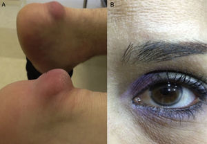 Clinical signs of familial hypercholesterolemia. (A) Achilles tendon xanthomas in a 56-year-old woman. (B) Corneal arcus in a 38-year-old woman.