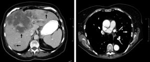 Axial images of contrast-enhanced CT of abdomen (left) and lungs (right). Dark arrows: liver masses. White arrow, a lung nodule.