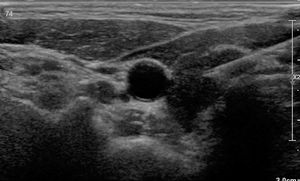 Thyroid gland ultrasound showing the right lobe with global hypoechogenicity and the 21G needle used for the intraglandular infiltration of triamcinolone.