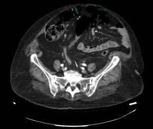 Axial CT scan of the abdomen, revealing the presence of bubbles in the anterior abdominal wall, which has a thickness of 3.8mm in some areas.