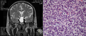 “Atypical” pituitary adenoma or well differentiated pituitary carcinoma in situ?