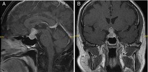 Magnetic resonance imaging (MRI) view of pituitary metastasis: (A) sagittal view in case 1 and (B) coronal view in case 2.