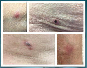 Bullous lesions in different evolutive stages in patients 1–3 (from left to right: upper images, patient 1; lower left corner, patient 2; lower right, patient 3).