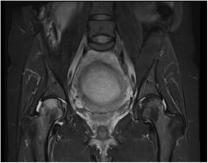 Magnetic resonance imaging view in T2-weighted sequencing showing intramedullary edema affecting the head and neck of the right femur and the head of the left femur, with no subchondral changes suggesting avascular necrosis or fracture, consistent with transient osteoporosis of the hip.