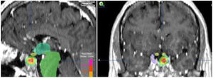 Dosimetry (MRI T1 post-gadolinium weighted coronal and sagittal images) of re-irradiation with radiosurgery (Novalis®), dose 12Gy, in a patient with an uncontrollable acromegaly with medical therapy. He had received fractionated stereotactic radiotherapy (54Gy) 12 years before.