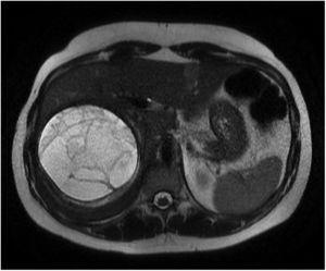 Abdominal MRI scan showing a large right adrenal mass.