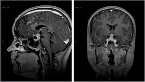 Magnetic resonance imaging view of a 15-year-old girl with a supra- and intrasellar tumor; three years before she had been diagnosed with isolated central diabetes insipidus and a widening of the pituitary stalk. The biopsy showed this to be a non-secreting germ cell tumor.