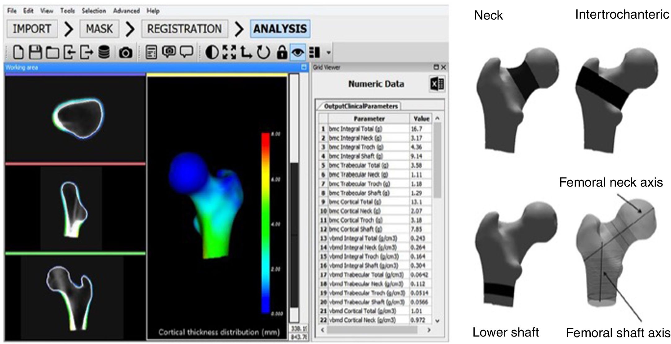 New technologies in the evaluation of bone fragility and their ...